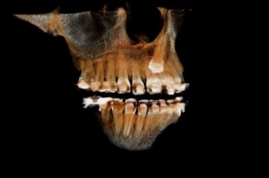 Impacted Canine Extraction