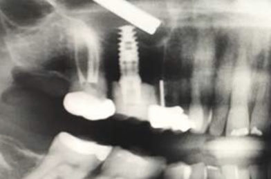 Implant Surgery