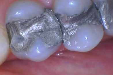 Dental Amalgam Hazard