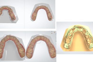 비발치교정- Damon orthodontics